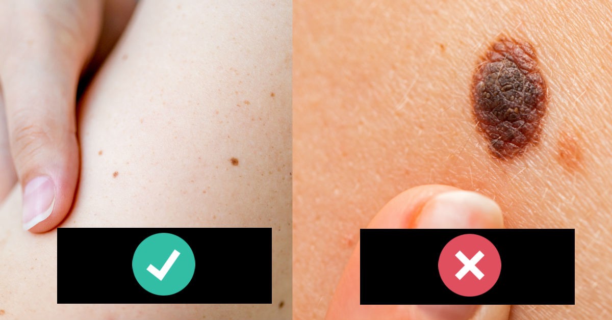 melanomas